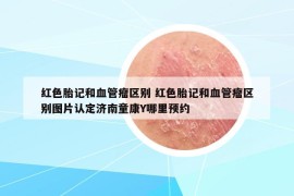 紅色胎記和血管瘤區(qū)別 紅色胎記和血管瘤區(qū)別圖片認定濟南童康Y哪里預約