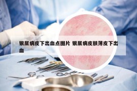銀屑病皮下出血點(diǎn)圖片 銀屑病皮膚薄皮下出血