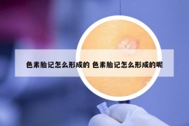 色素胎記怎么形成的 色素胎記怎么形成的呢