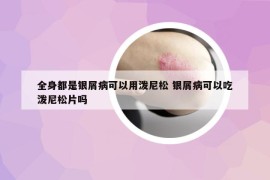 全身都是銀屑病可以用潑尼松 銀屑病可以吃潑尼松片嗎