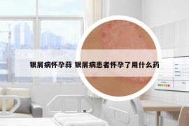 銀屑病懷孕蒜 銀屑病患者懷孕了用什么藥