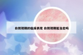 白斑初期的臨床表現(xiàn) 白斑初期能治愈嗎