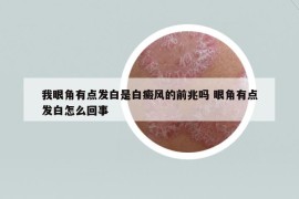 我眼角有點(diǎn)發(fā)白是白癜風(fēng)的前兆嗎 眼角有點(diǎn)發(fā)白怎么回事