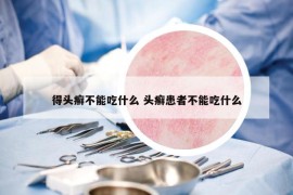 得頭癬不能吃什么 頭癬患者不能吃什么
