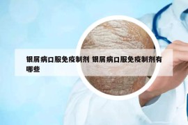 銀屑病口服免疫制劑 銀屑病口服免疫制劑有哪些
