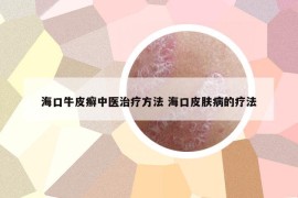 海口牛皮癬中醫(yī)治療方法 ?？谄つw病的療法