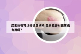 尿素軟膏可以擦銀屑病嗎 尿素軟膏對銀屑病有用嗎?