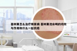 喜樹果怎么治療銀屑病 喜樹果泡水喝的功效與作用和什么一起抗癌