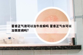 藿香正氣液可以治牛皮癬嗎 藿香正氣水可以治銀屑病嗎?