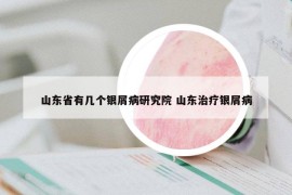 山東省有幾個銀屑病研究院 山東治療銀屑病