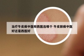 治療牛皮癬中醫(yī)和西醫(yī)選哪個(gè) 牛皮膚癬中醫(yī)好還是西醫(yī)好