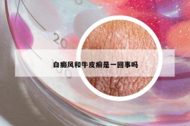 白癜風(fēng)和牛皮癬是一回事嗎