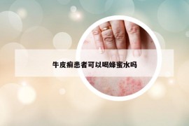 牛皮癬患者可以喝蜂蜜水嗎