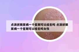 點滴狀銀屑病一個星期可以痊愈嗎 點滴狀銀屑病一個星期可以痊愈嗎女性