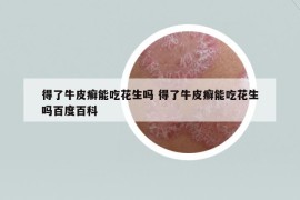 得了牛皮癬能吃花生嗎 得了牛皮癬能吃花生嗎百度百科