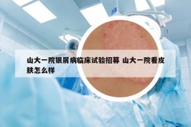山大一院銀屑病臨床試驗招募 山大一院看皮膚怎么樣