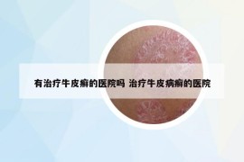 有治療牛皮癬的醫(yī)院?jiǎn)?治療牛皮病癬的醫(yī)院