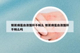 銀屑病是血液循環(huán)不暢么 銀屑病是血液循環(huán)不暢么嗎