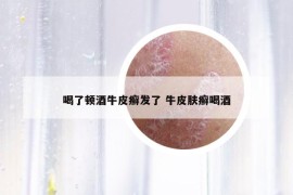 喝了頓酒牛皮癬發(fā)了 牛皮膚癬喝酒