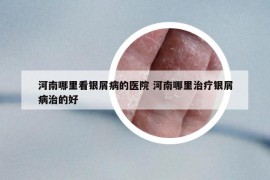 河南哪里看銀屑病的醫(yī)院 河南哪里治療銀屑病治的好