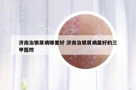 濟南治銀屑病哪里好 濟南治銀屑病最好的三甲醫(yī)院
