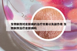 生物制劑對(duì)皮膚病的治療效果以及副作用 生物制劑治療皮膚病嗎