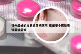 福州最好的皮膚銀屑病醫(yī)院 福州哪個醫(yī)院看銀屑病最好