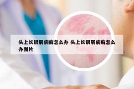 頭上長銀屑病癬怎么辦 頭上長銀屑病癬怎么辦圖片