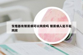 生殖器有銀屑病可以同房嗎 銀屑病人能不能同房