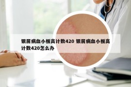 銀屑病血小板高計數(shù)420 銀屑病血小板高計數(shù)420怎么辦