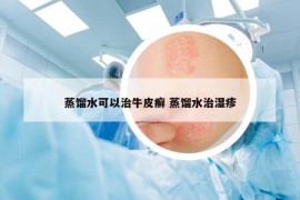 蒸餾水可以治牛皮癬 蒸餾水治濕疹