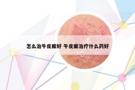 怎么治牛皮廨好 牛皮廨治療什么藥好