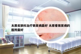 太原皮膚科治療銀屑病最好 太原看銀屑病的醫(yī)院最好
