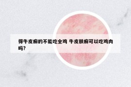得牛皮癬的不能吃全雞 牛皮膚癬可以吃雞肉嗎?
