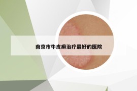 南京市牛皮癬治療最好的醫(yī)院