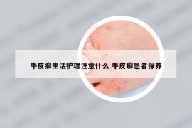 牛皮癬生活護(hù)理注意什么 牛皮癬患者保養(yǎng)
