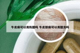 牛皮癬可以用陳醋嗎 牛皮膚癬可以用醋洗嗎