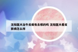 沈陽醫(yī)大治牛皮癬有去根的嗎 沈陽醫(yī)大看皮膚病怎么樣