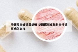 華西能治好銀屑病嘛 華西醫(yī)院皮膚科治療銀屑病怎么樣