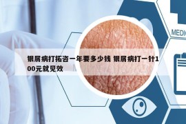 銀屑病打拓咨一年要多少錢 銀屑病打一針100元就見效