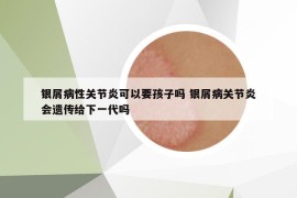 銀屑病性關(guān)節(jié)炎可以要孩子嗎 銀屑病關(guān)節(jié)炎會遺傳給下一代嗎