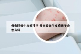 母親輕微牛皮癬孩子 母親輕微牛皮癬孩子會(huì)怎么樣