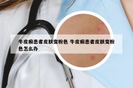牛皮癬患者皮膚變粉色 牛皮癬患者皮膚變粉色怎么辦