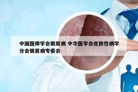 中國(guó)醫(yī)師學(xué)會(huì)銀屑病 中華醫(yī)學(xué)會(huì)皮膚性病學(xué)分會(huì)銀屑病專委會(huì)