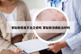 掌趾膿皰是不治之癥嗎 掌趾膿泡病能治好嗎