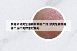 類克和修美樂治銀屑病哪個(gè)好 修美樂和類克哪個(gè)治療克羅恩效果好