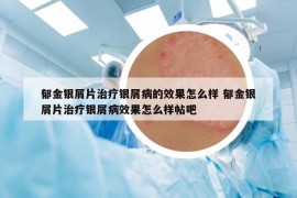 郁金銀屑片治療銀屑病的效果怎么樣 郁金銀屑片治療銀屑病效果怎么樣帖吧