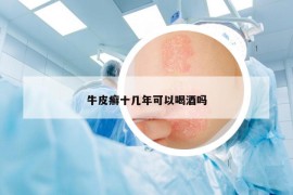 牛皮癬十幾年可以喝酒嗎