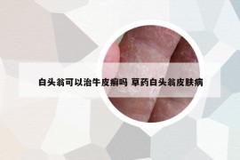 白頭翁可以治牛皮癬嗎 草藥白頭翁皮膚病