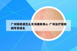 廣州銀屑病怎么先詢康膚用心 廣州治療銀屑病專家排名